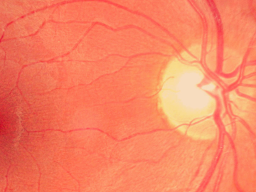 Cystoid Macular Edema