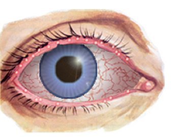Blepharitis - Inflammation of the Eyelids