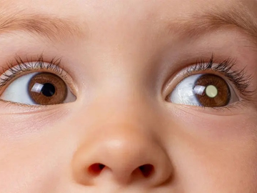 Retinoblastoma