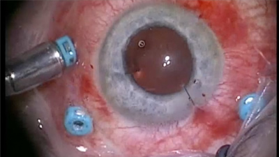 cataractvitrectomy