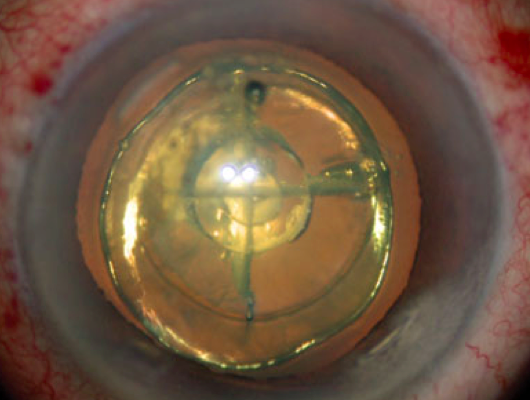 lensfragmentation