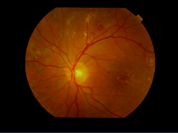 losteyedisease
