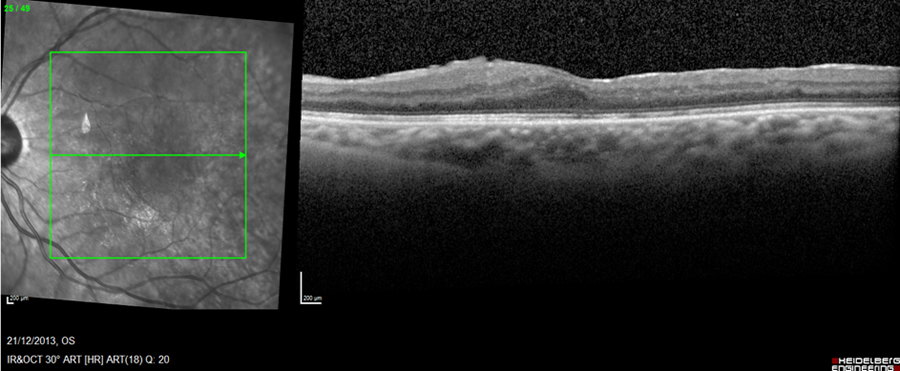 post-diabeticretinopathy
