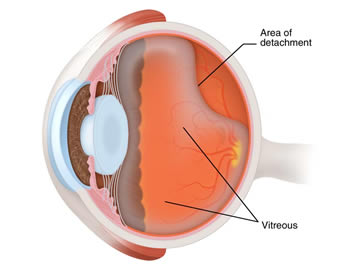 posterior-vitreous-detachment