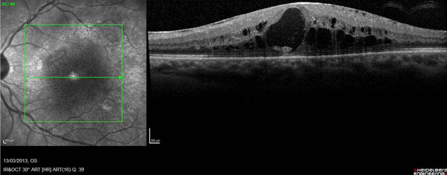 pre-diabeticretinopathy