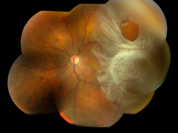 retinaldetachmentofeye